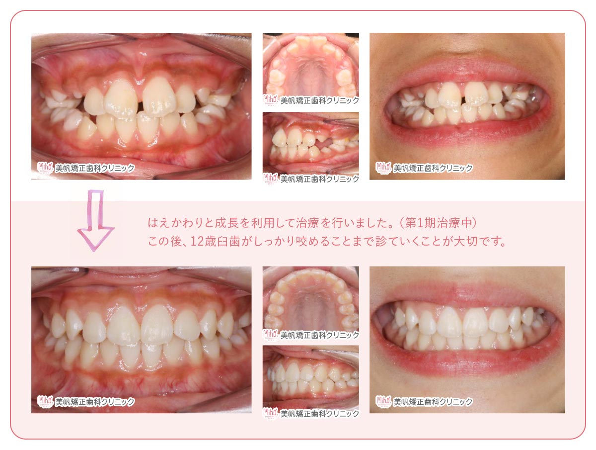 こどもの矯正治療 美帆矯正歯科クリニック