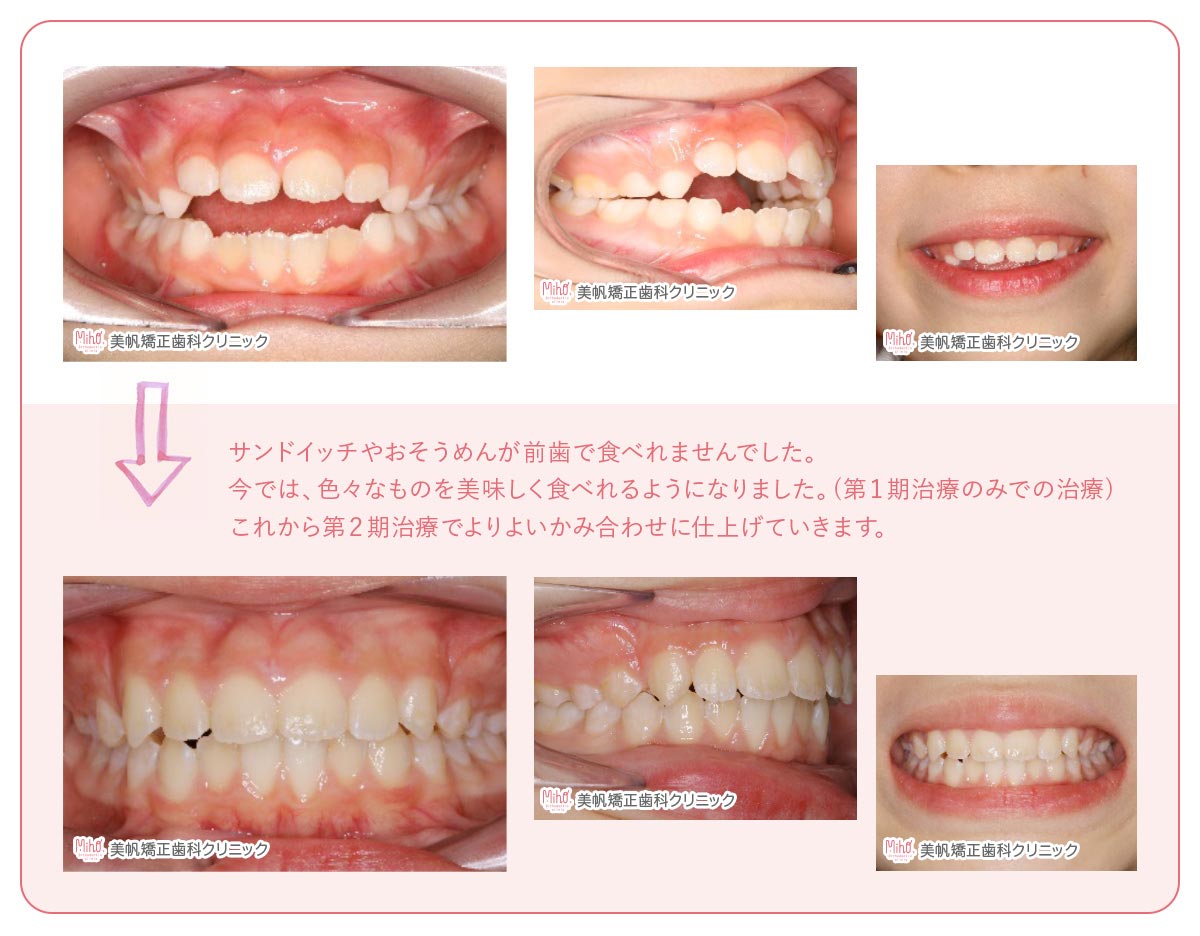 こどもの矯正治療 美帆矯正歯科クリニック